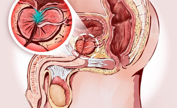 Riabilitazione del pavimento pelvico post prostatectomia