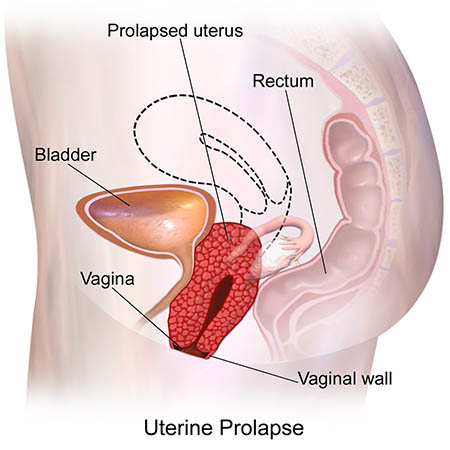 Prolasso uterino, prolasso rettale e prolasso della vescica