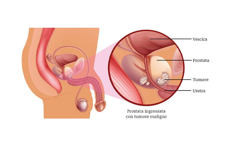 intervento di prostatectomia radicale robotica